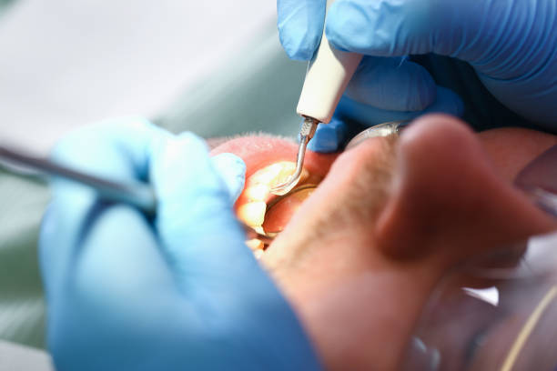 Best Emergency Tooth Extraction in Jerseyvle, IL