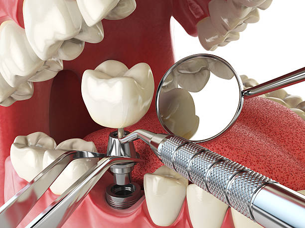 Best Emergency Treatment for Toothache in Jerseyvle, IL